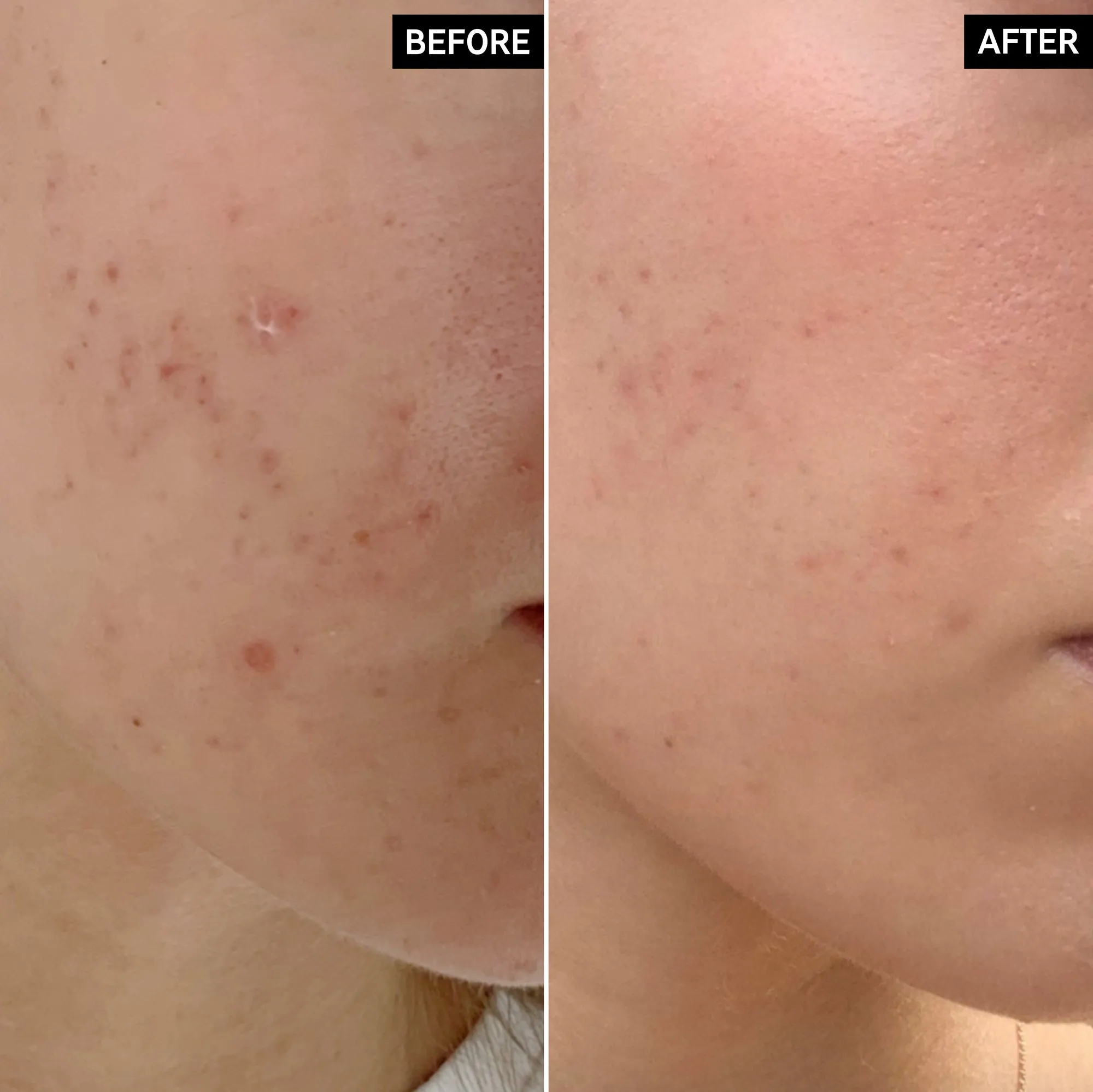 Mandelic Acid Treatment